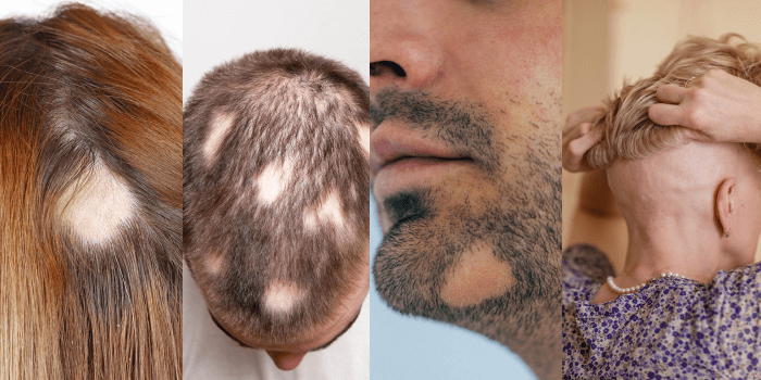 How to Stop Alopecia Areata from Spreading | Senderra