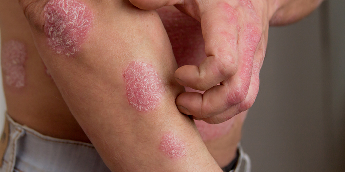 What Helps Psoriasis