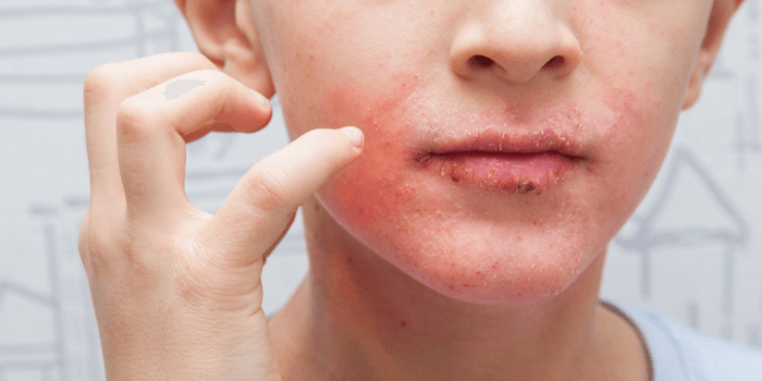 Sensitive Skin SOS: Navigating Eczema and Atopic Dermatitis